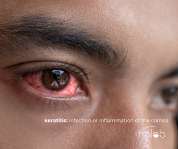 person face with red inflammed eye from keratitis Rocky Mountain Lions Eye Bank logo