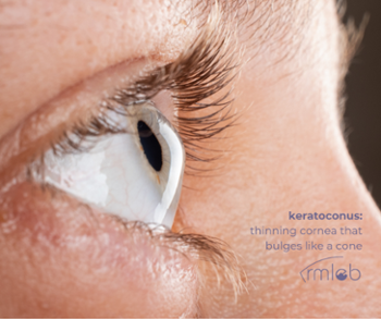 person eye up close with bulging shape cornea keratoconus Rocky Mountain Lions Eye Bank logo