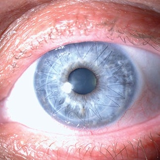 up close of blue eye iris showing stitches of cornea transplant surgery